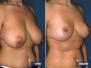 cirugía de reducción mamaria