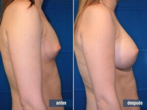 cirugía de aumento de mamas